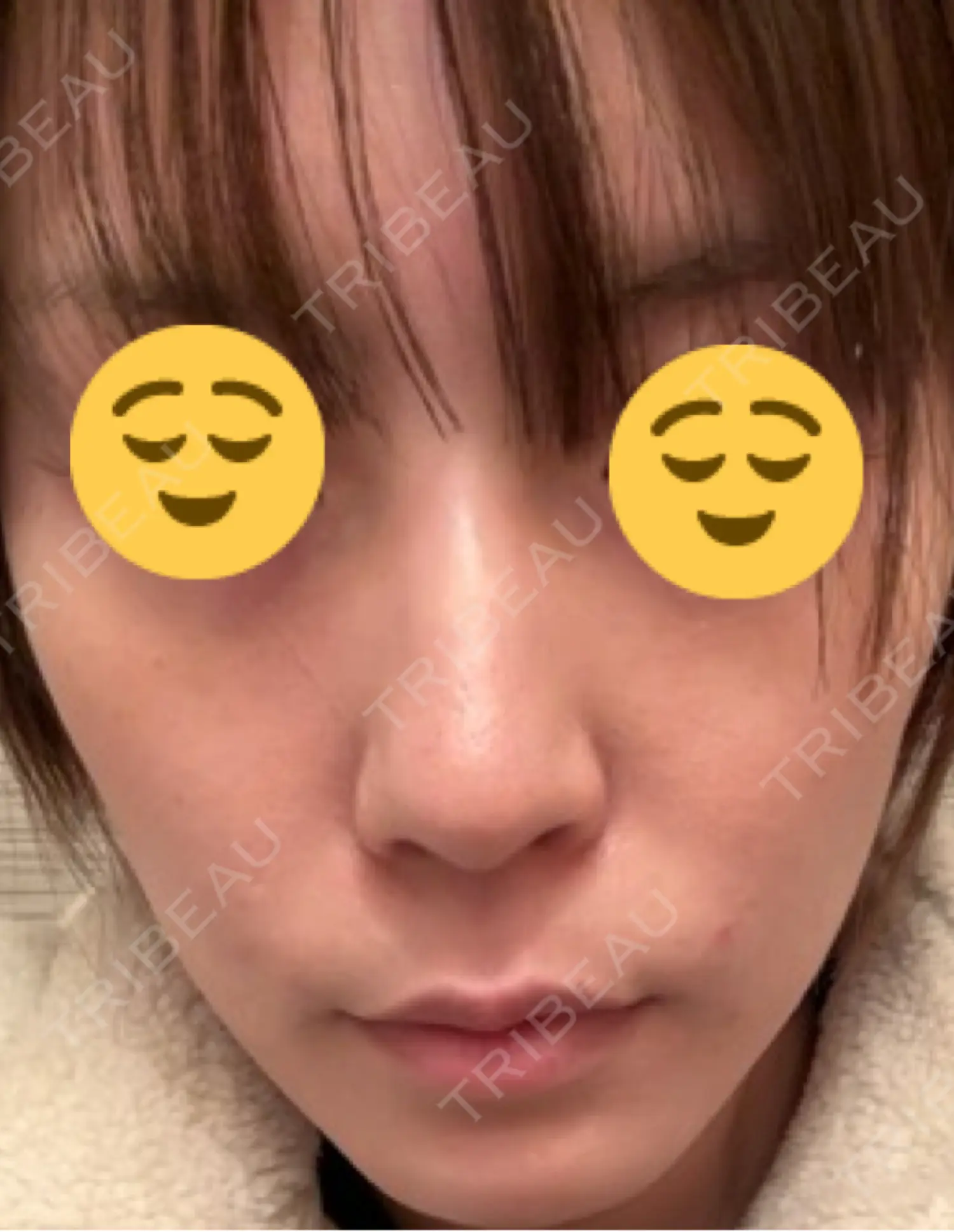 施術後の写真