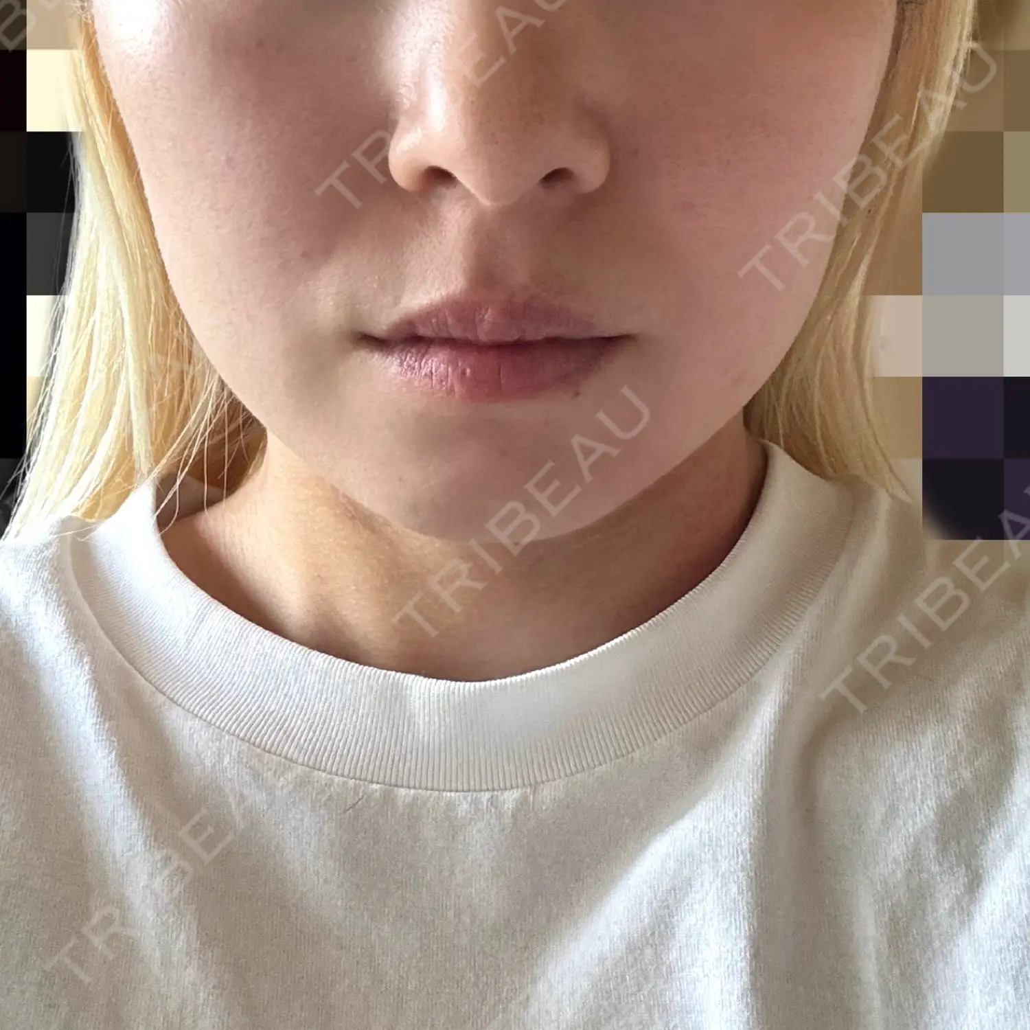 施術後の写真