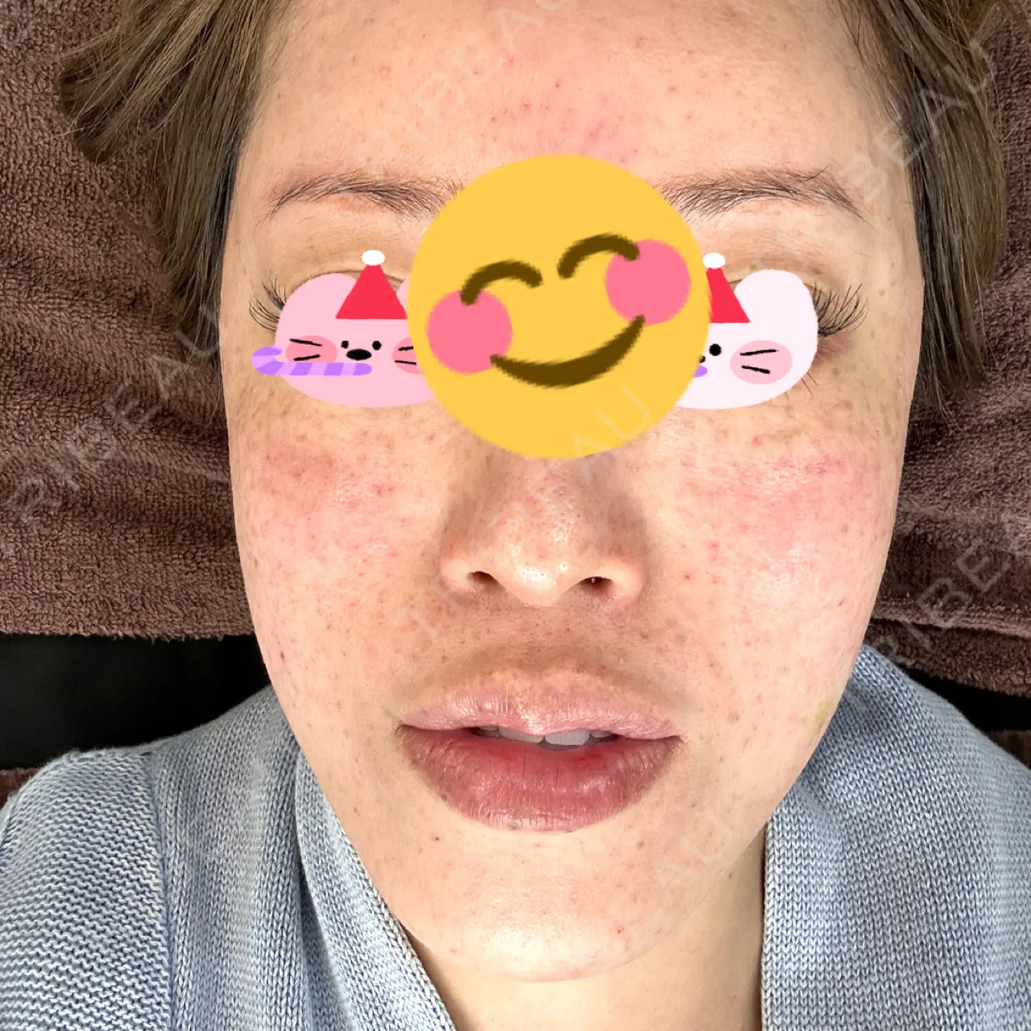施術後の写真