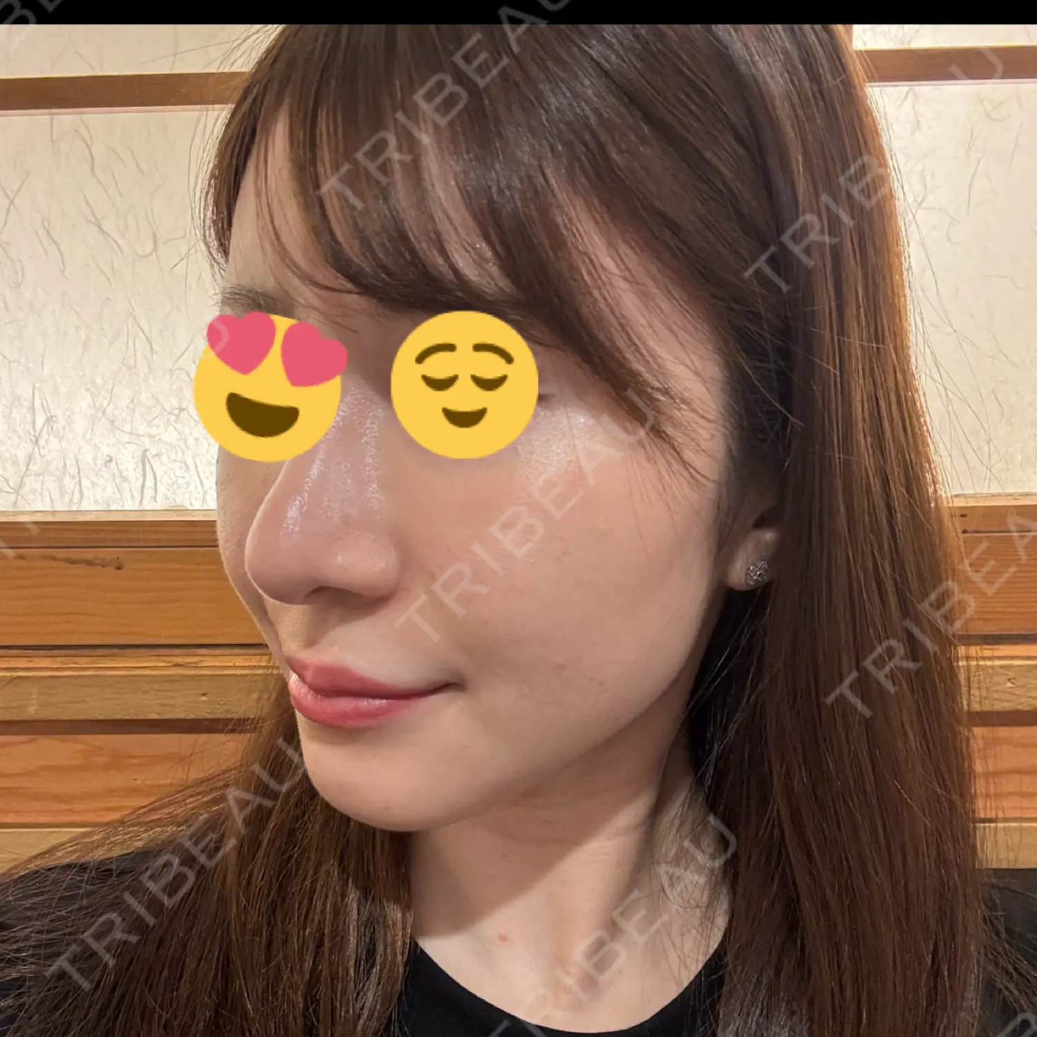施術後の写真