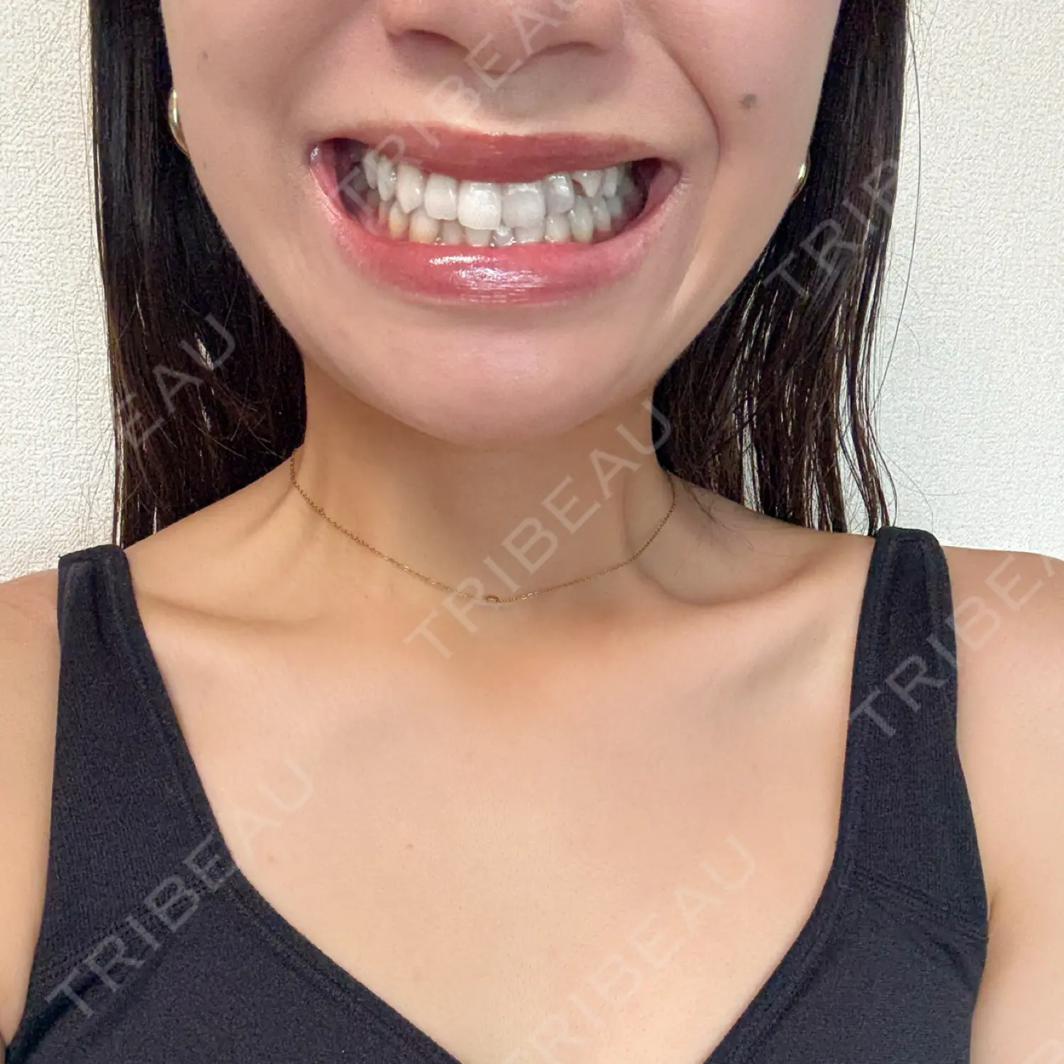 施術後の写真