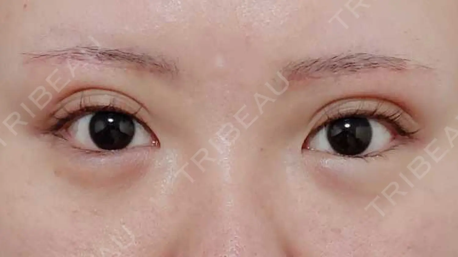 施術後の写真