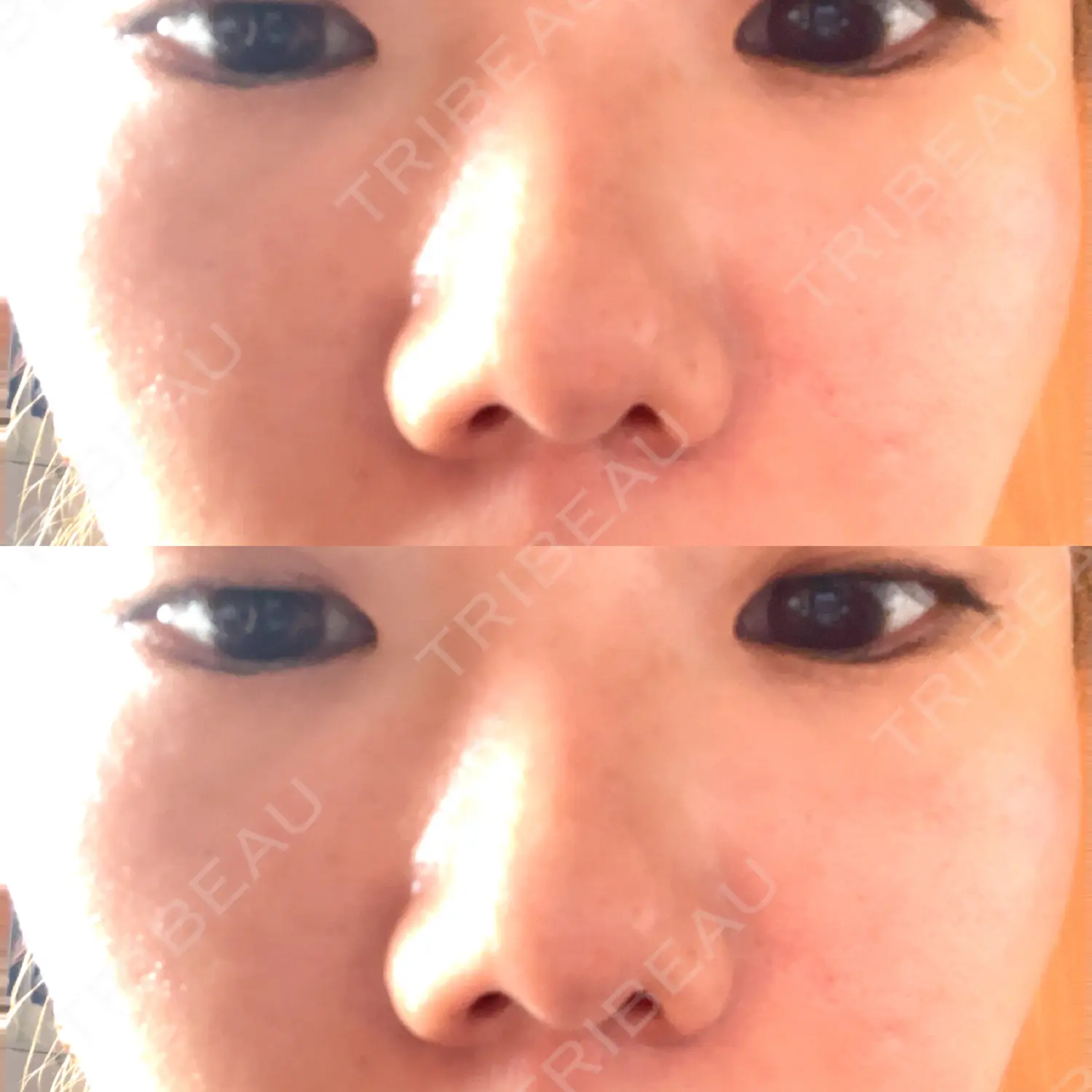 施術後の写真