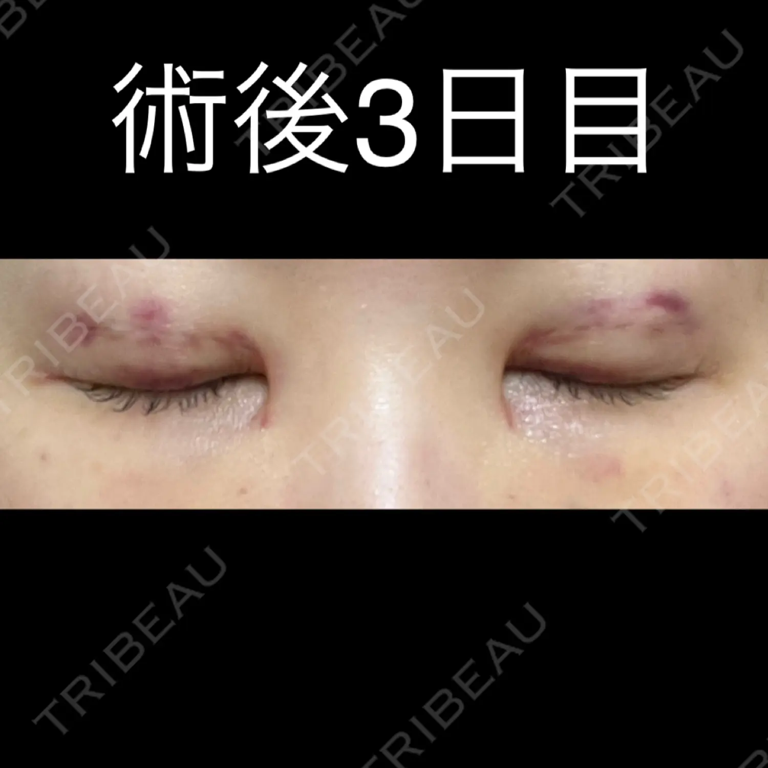 施術後の写真