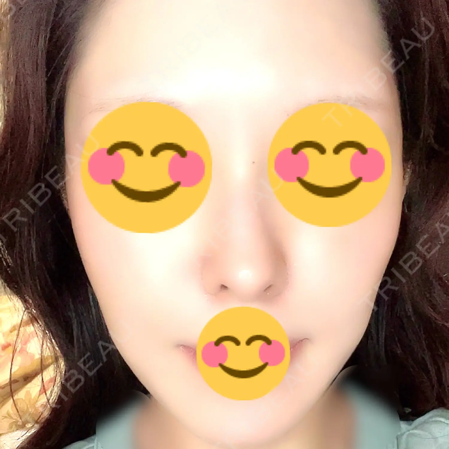 施術後の写真