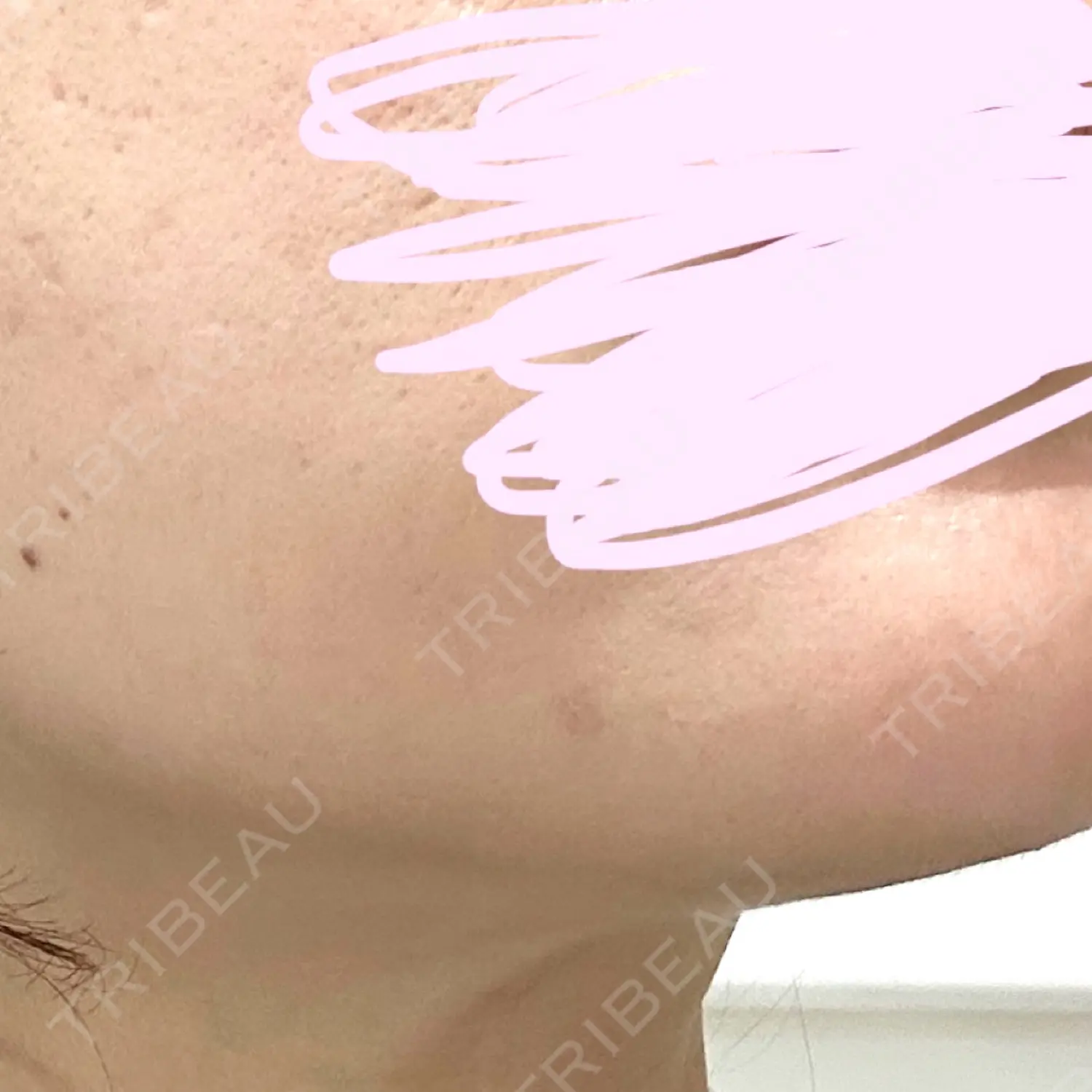 施術後の写真