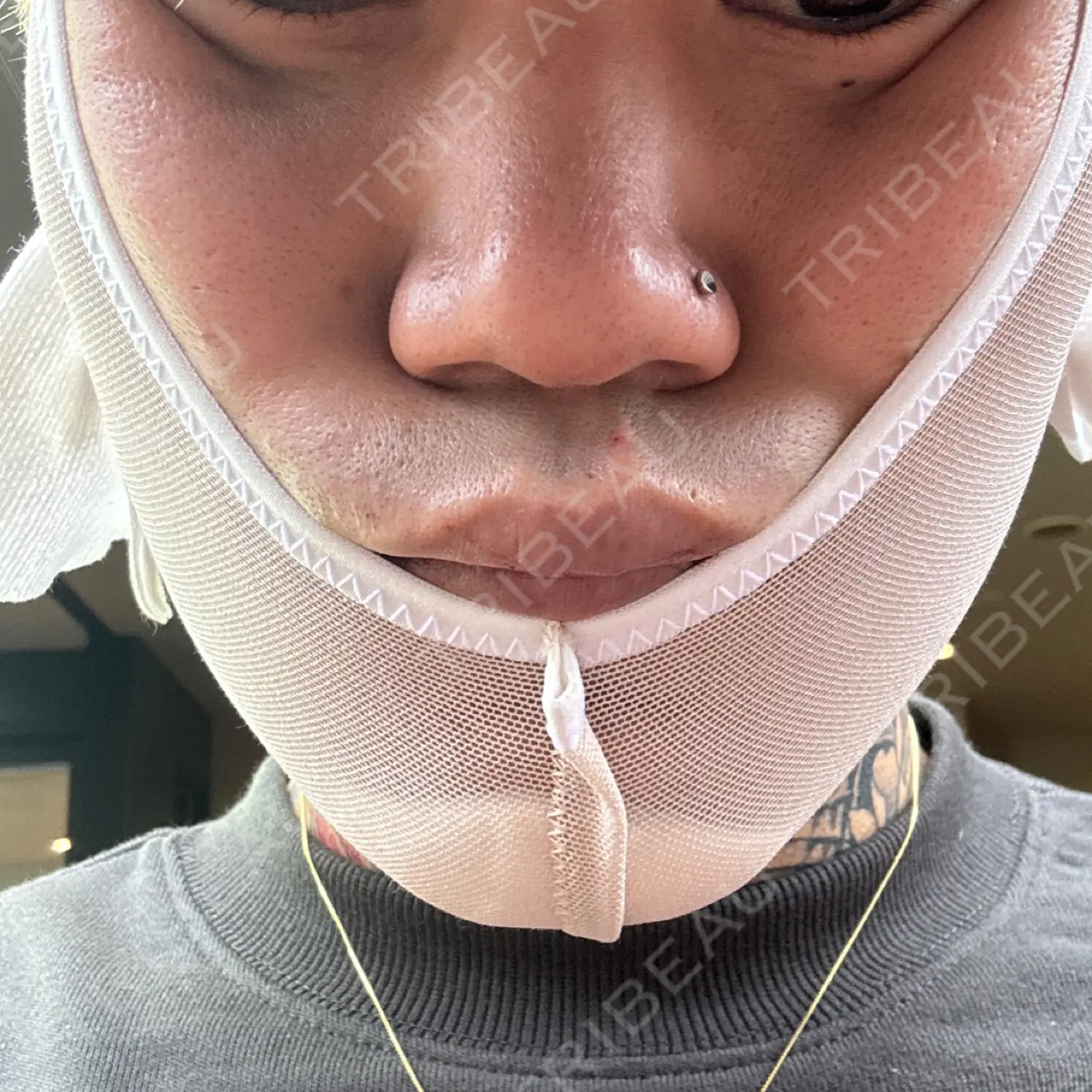 施術後の写真