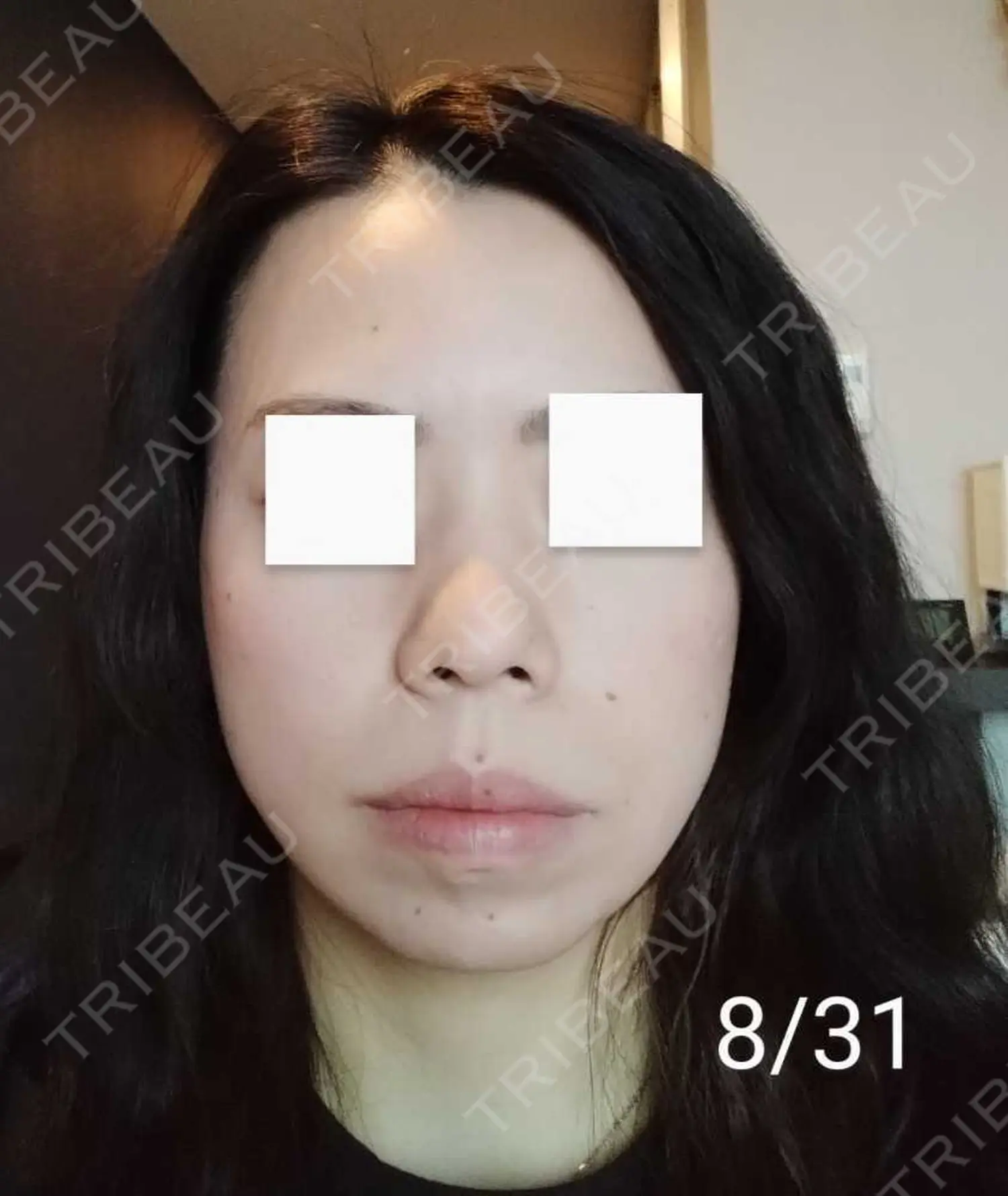 施術後の写真