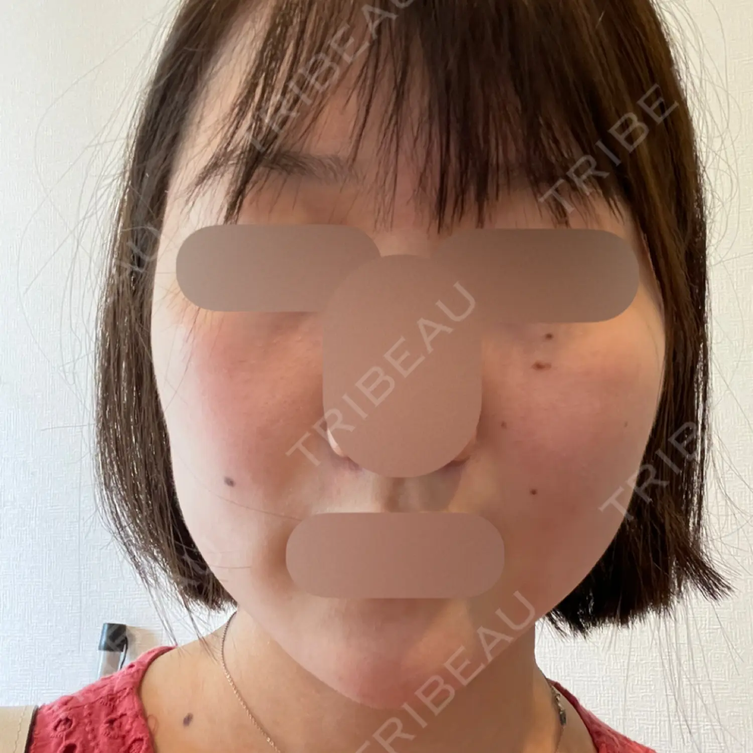 施術後の写真