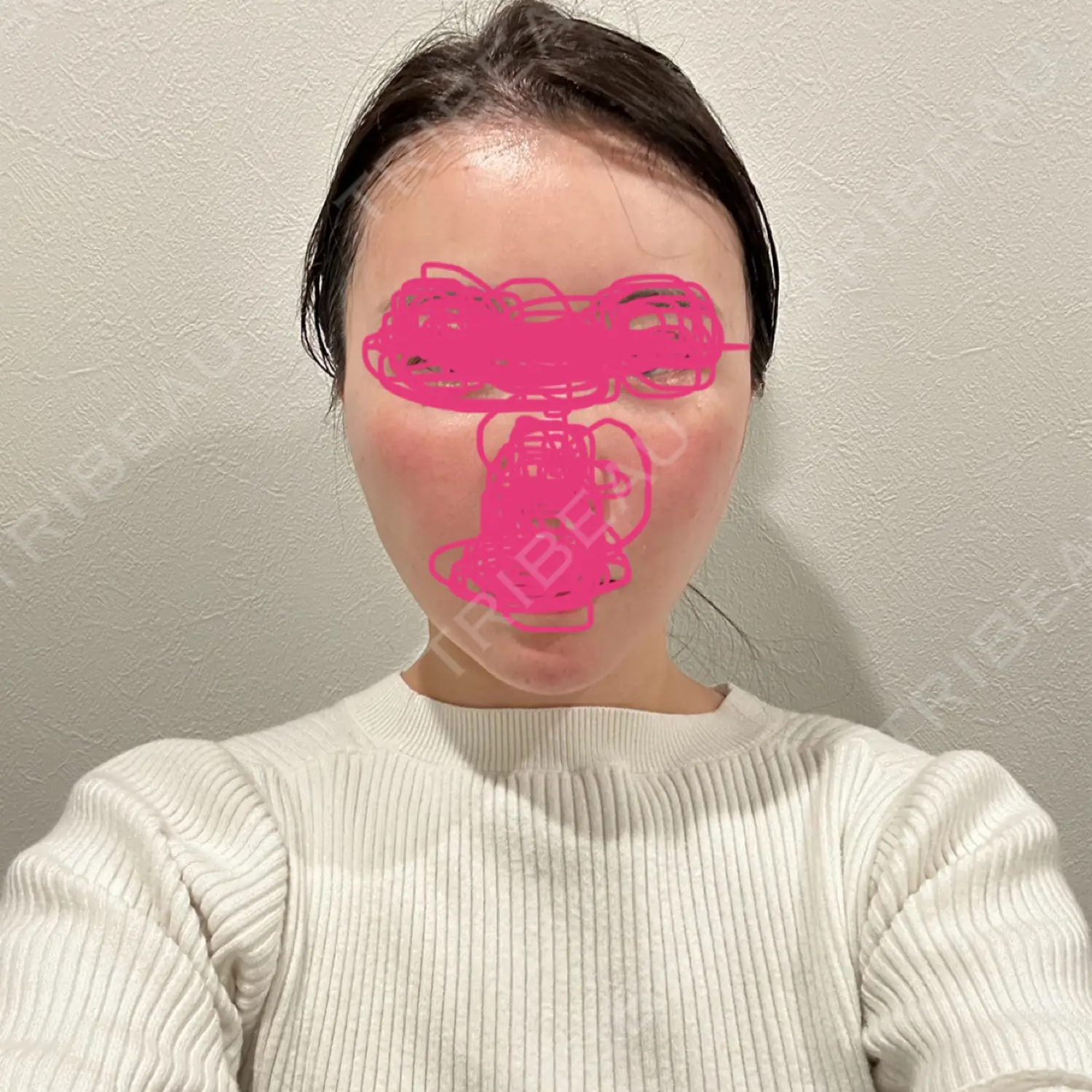 施術後の写真