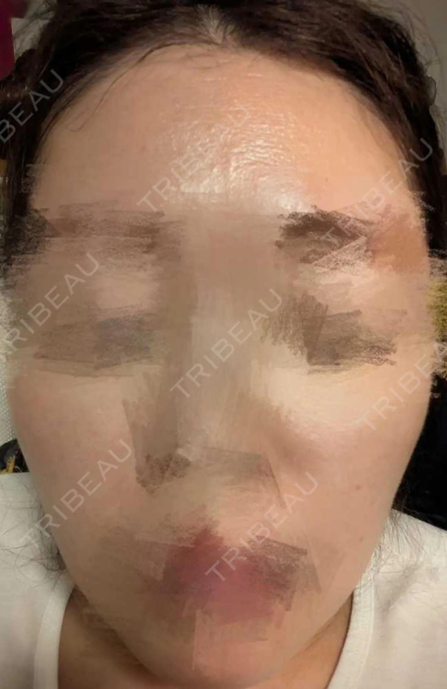 施術後の写真