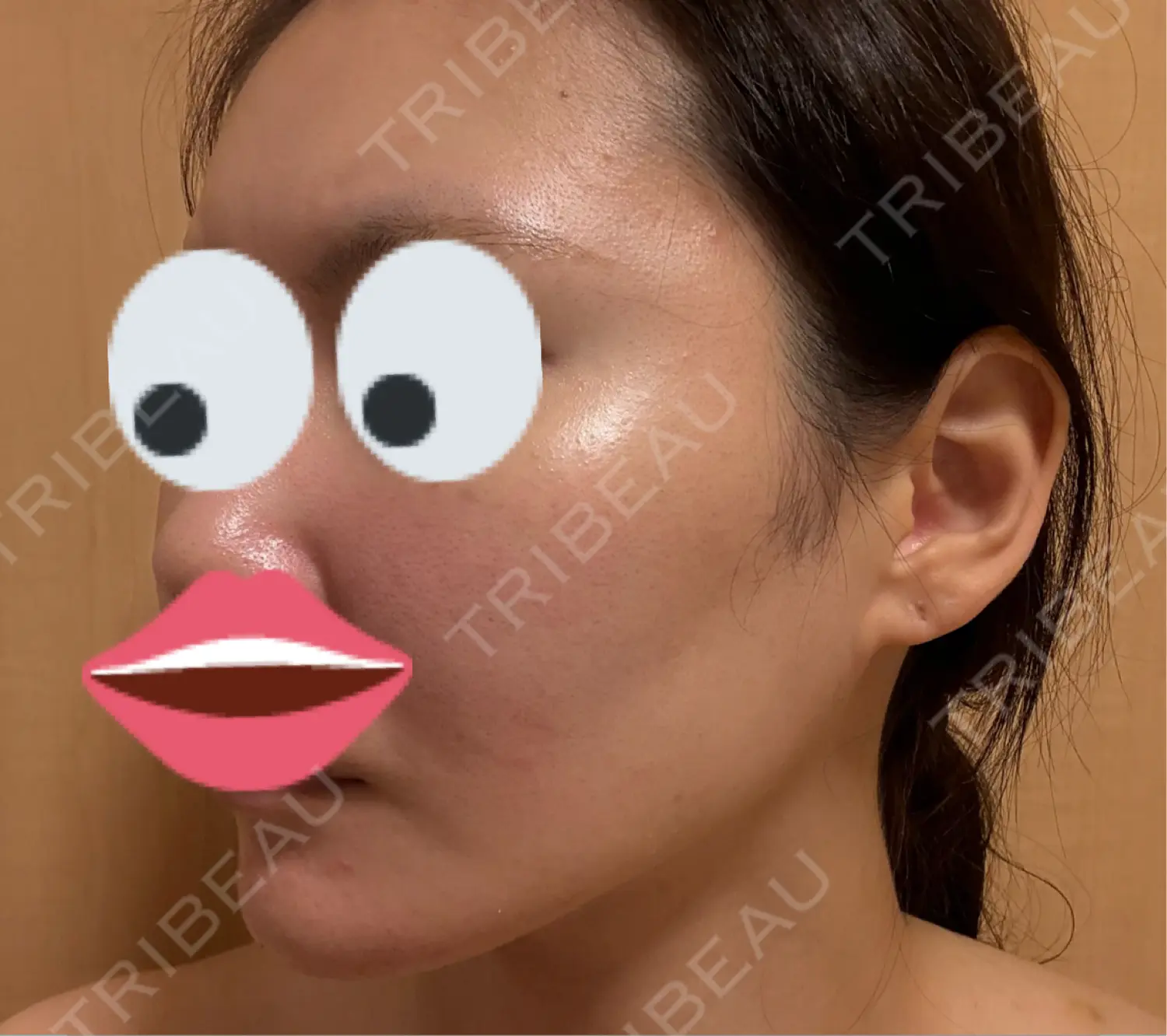 施術後の写真