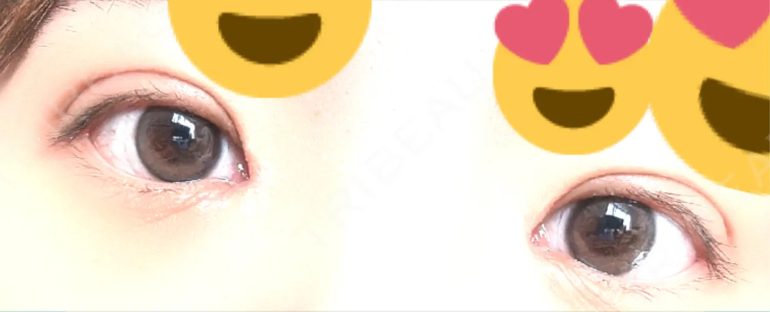 施術後の写真