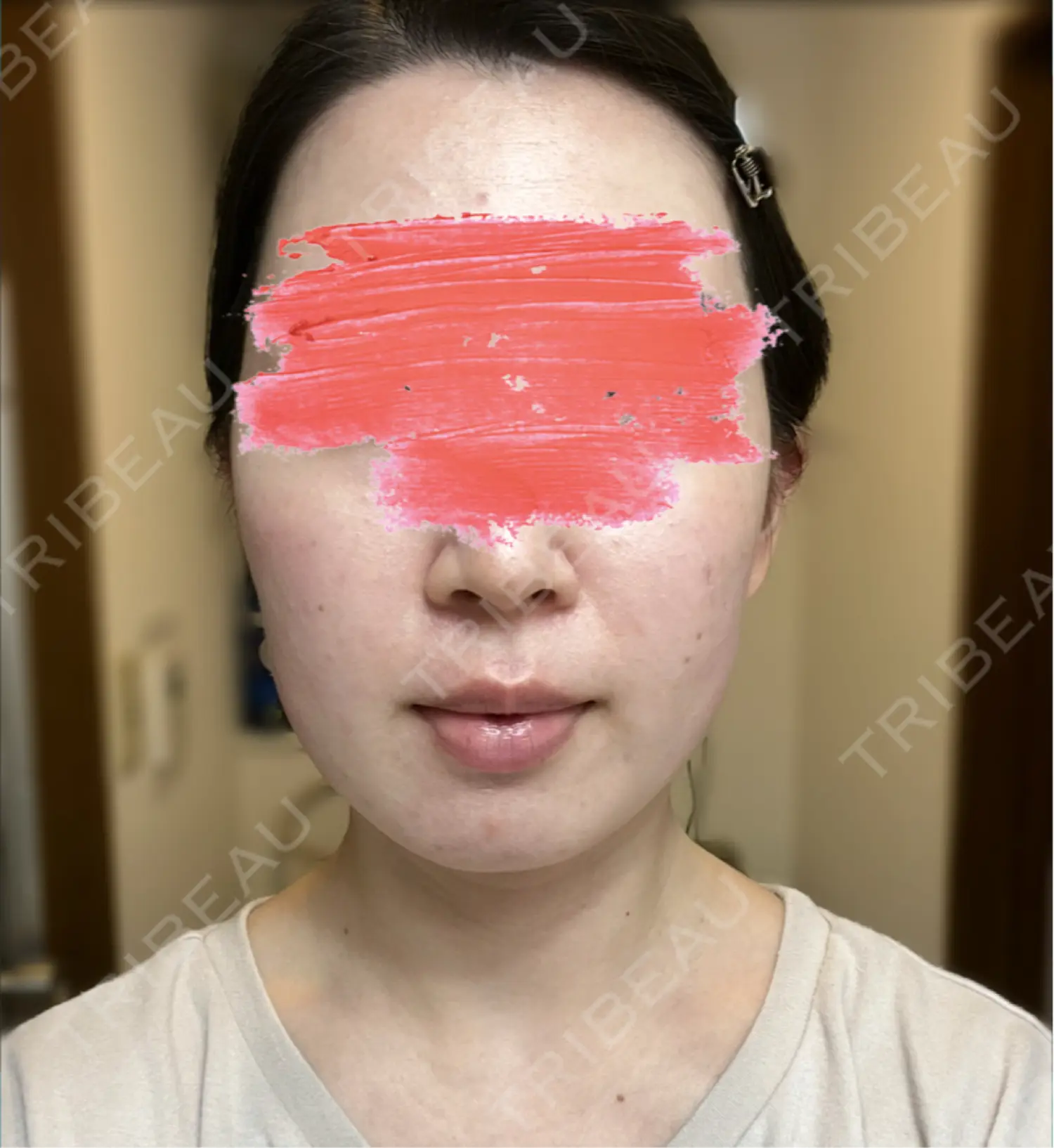 施術後の写真