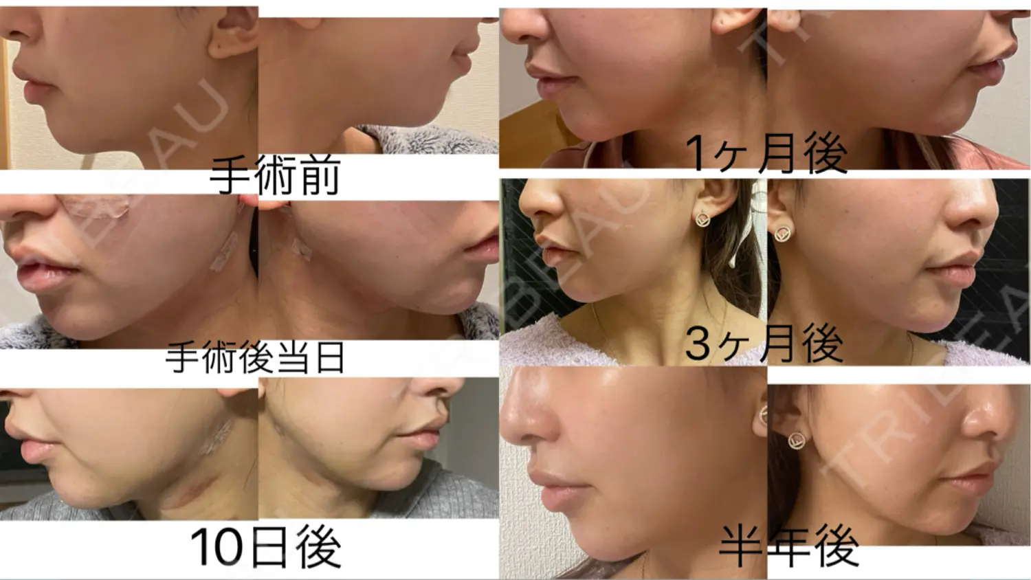 施術後の写真