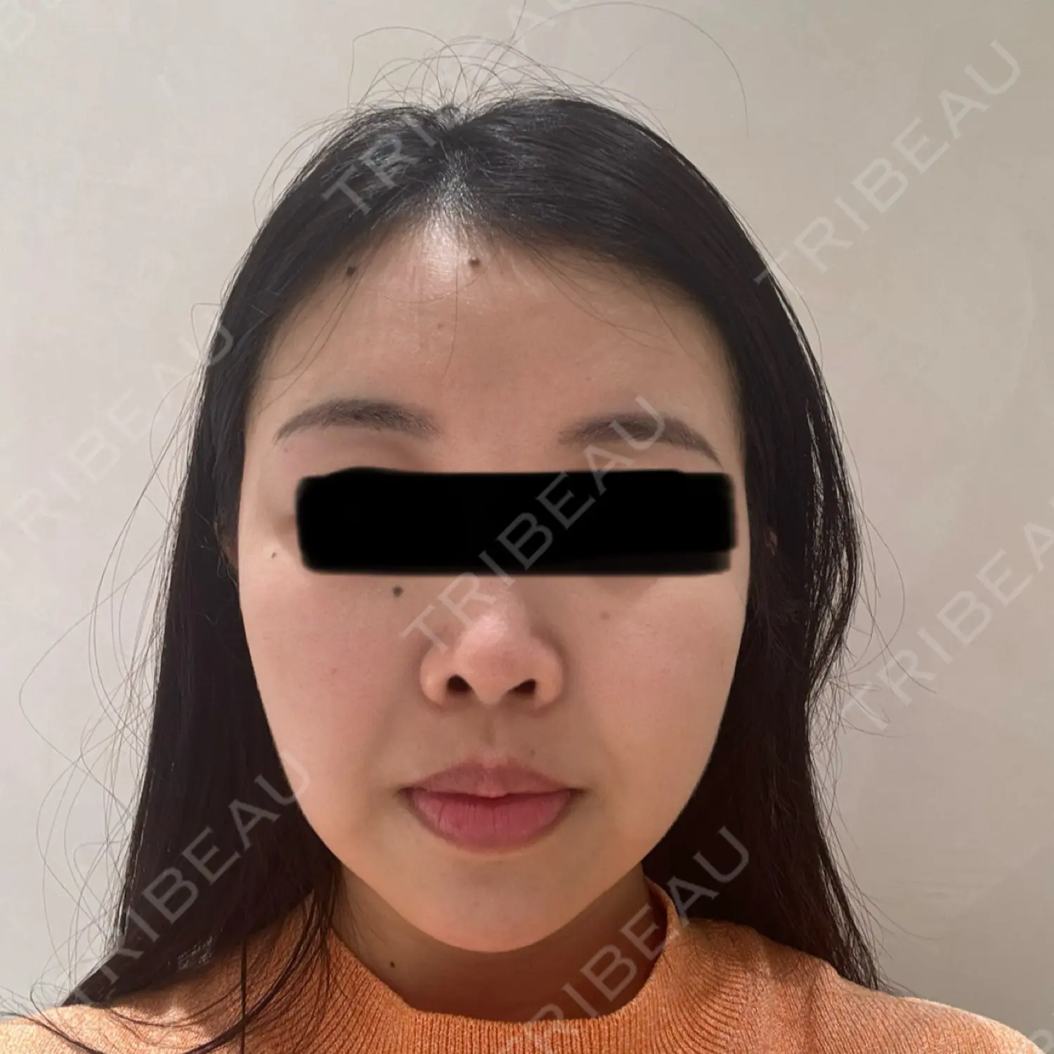 施術後の写真