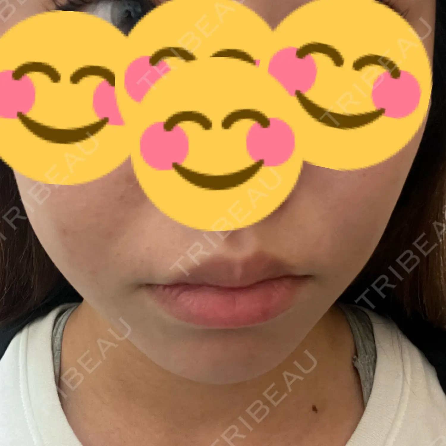 施術後の写真