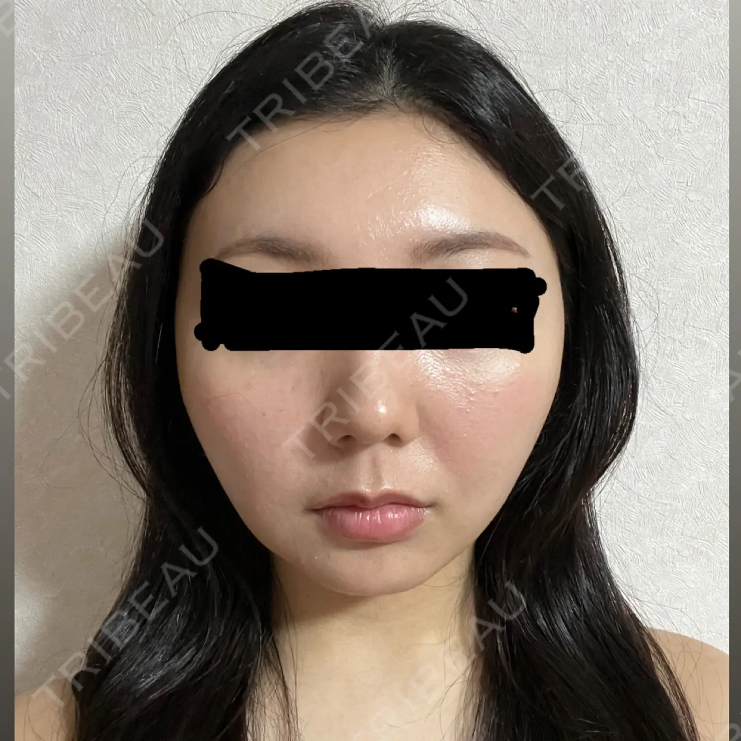 施術後の写真