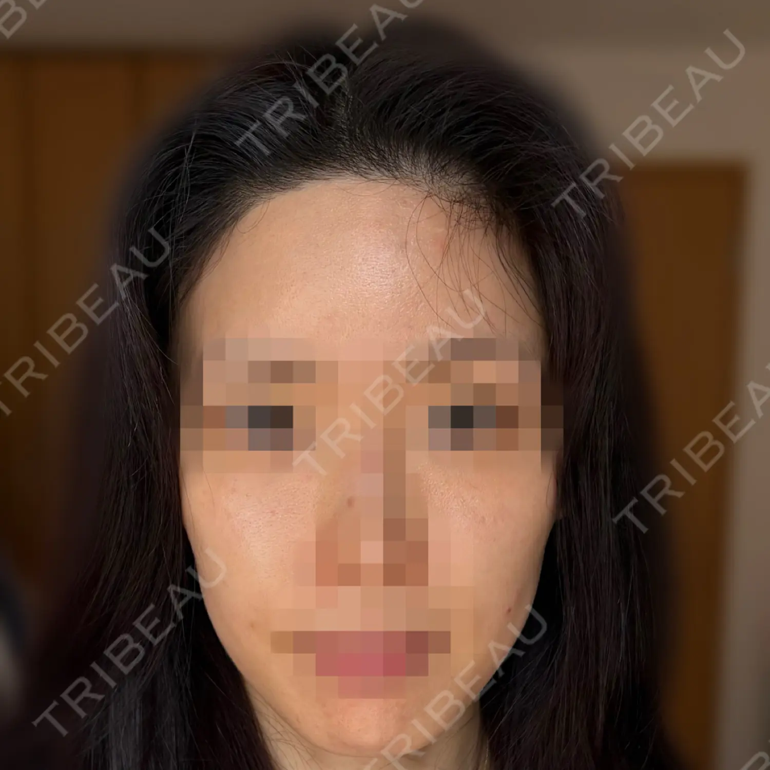 施術後の写真