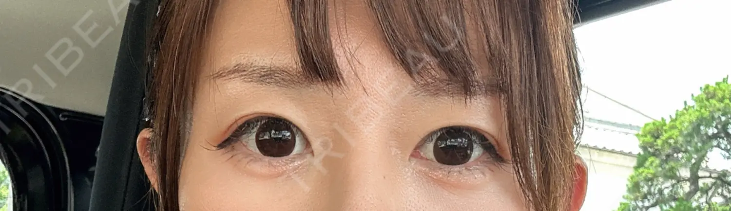 施術後の写真