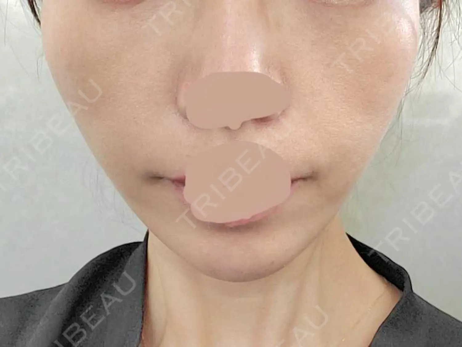 施術後の写真