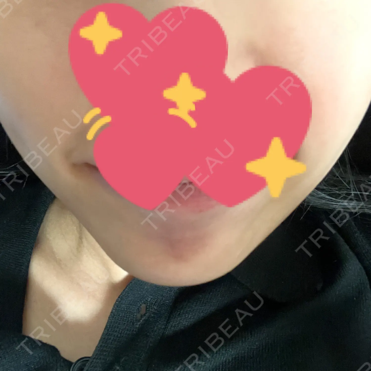 施術後の写真