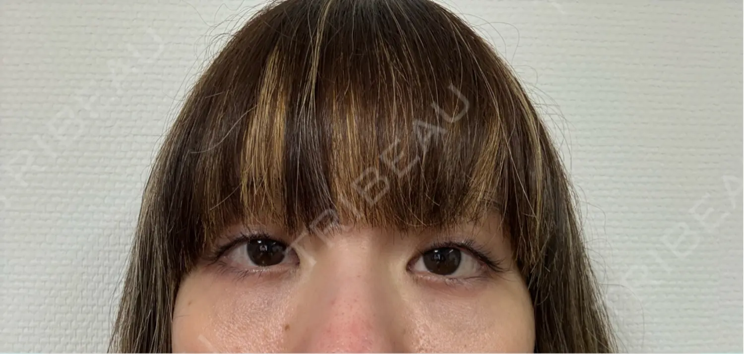 施術後の写真