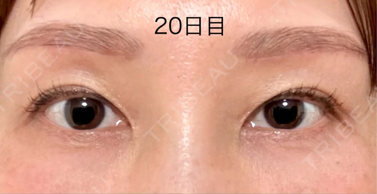 施術後の写真