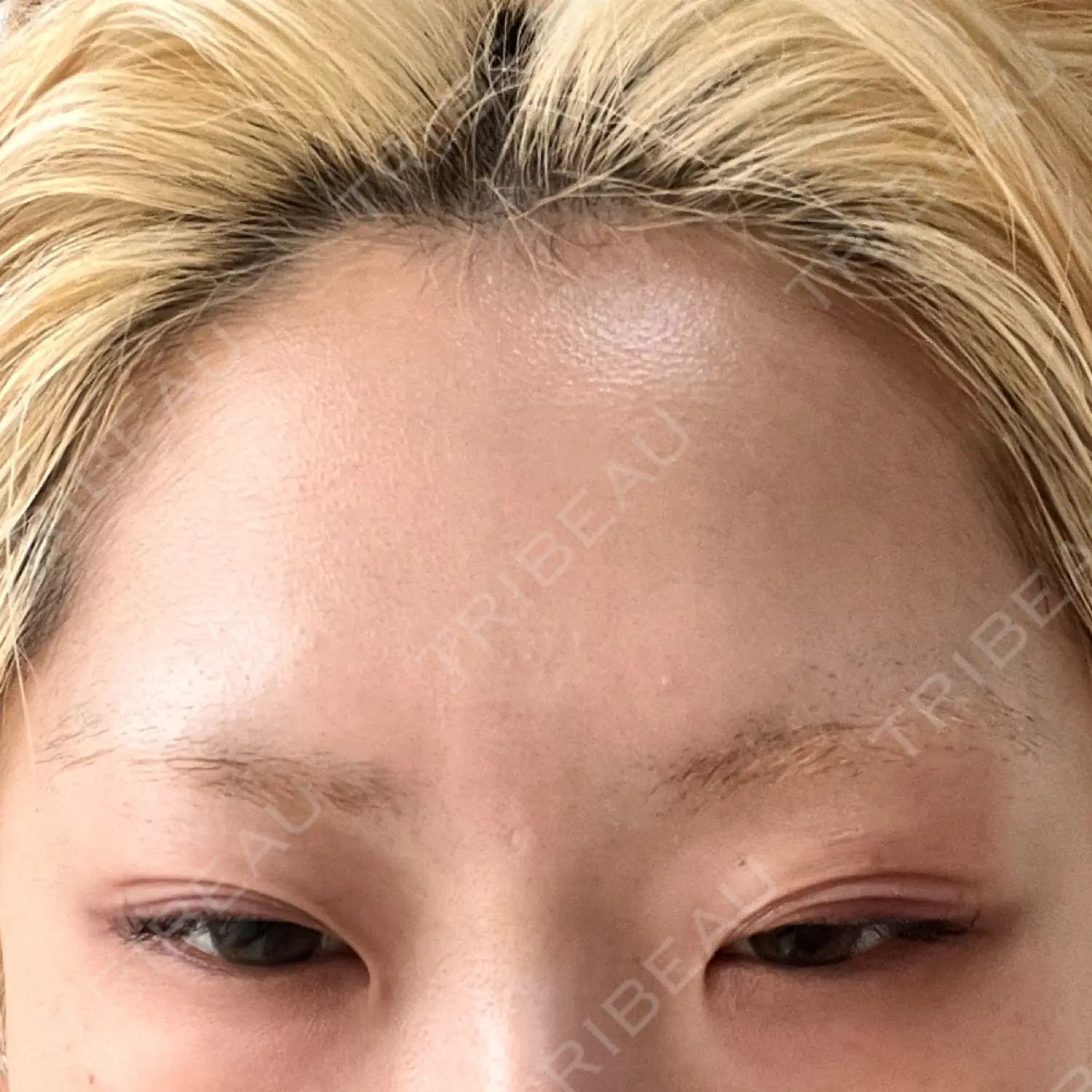 施術後の写真