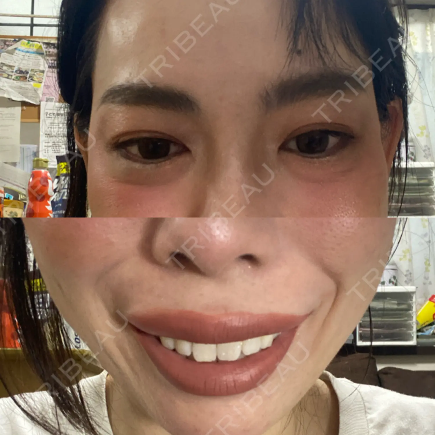 施術後の写真