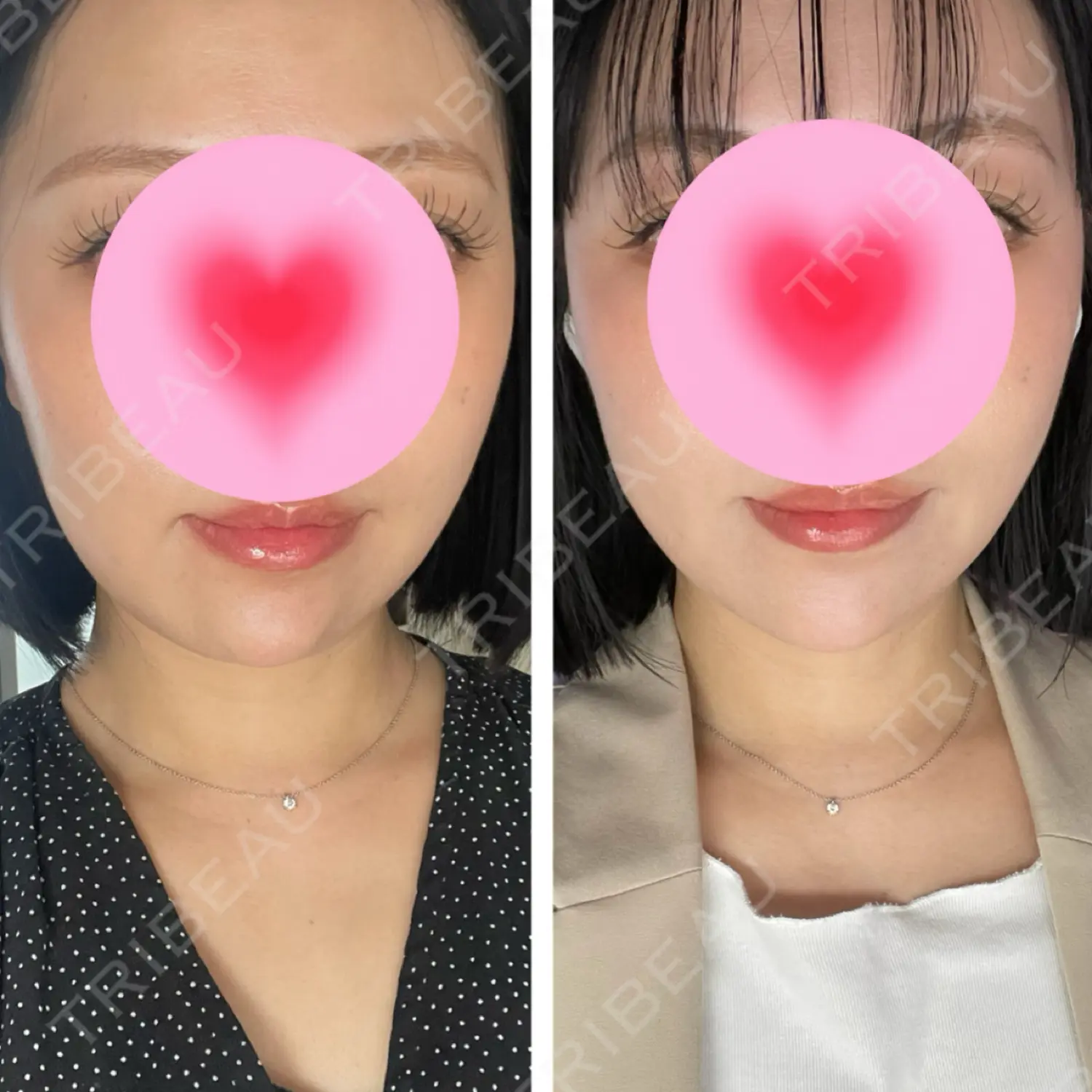 施術後の写真