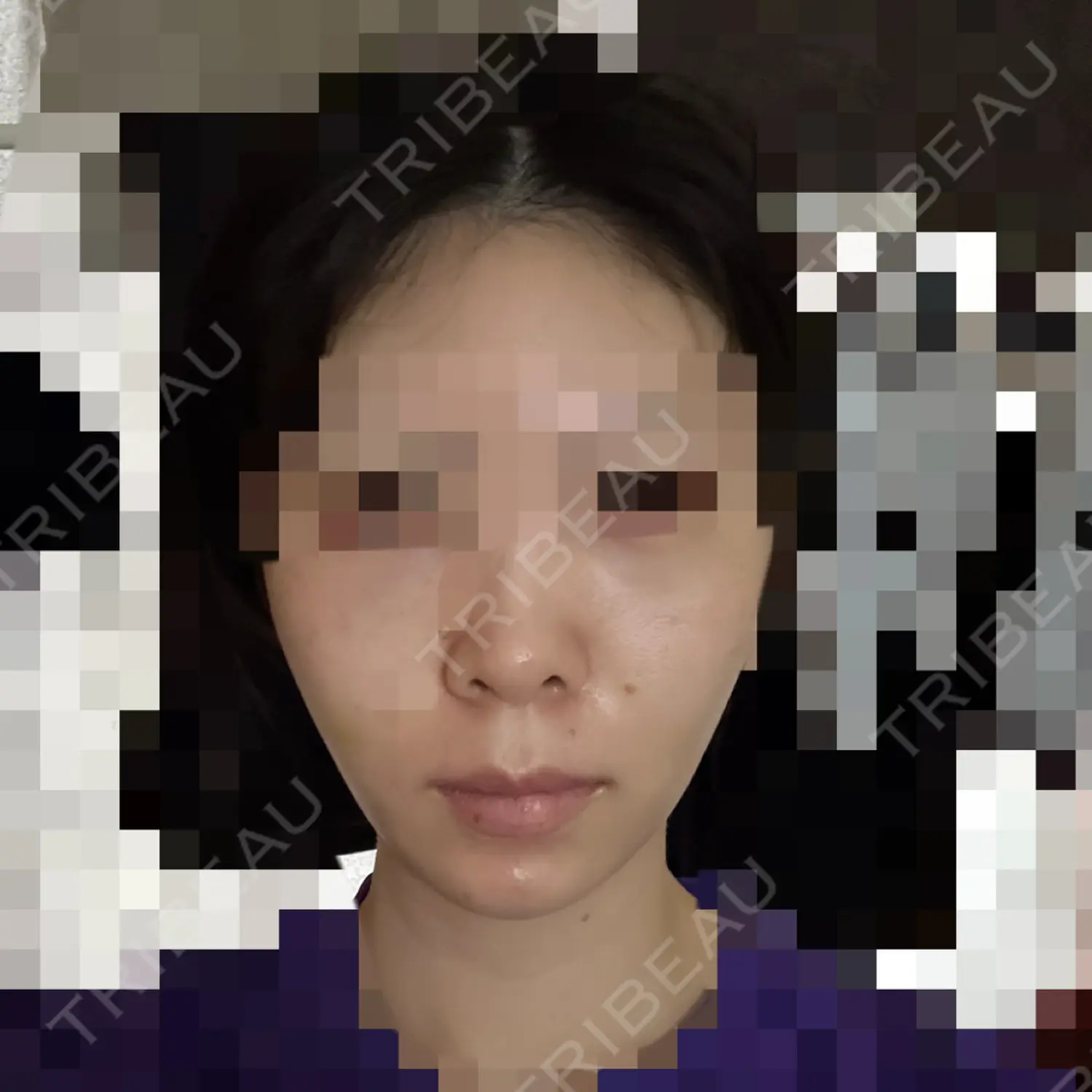施術後の写真