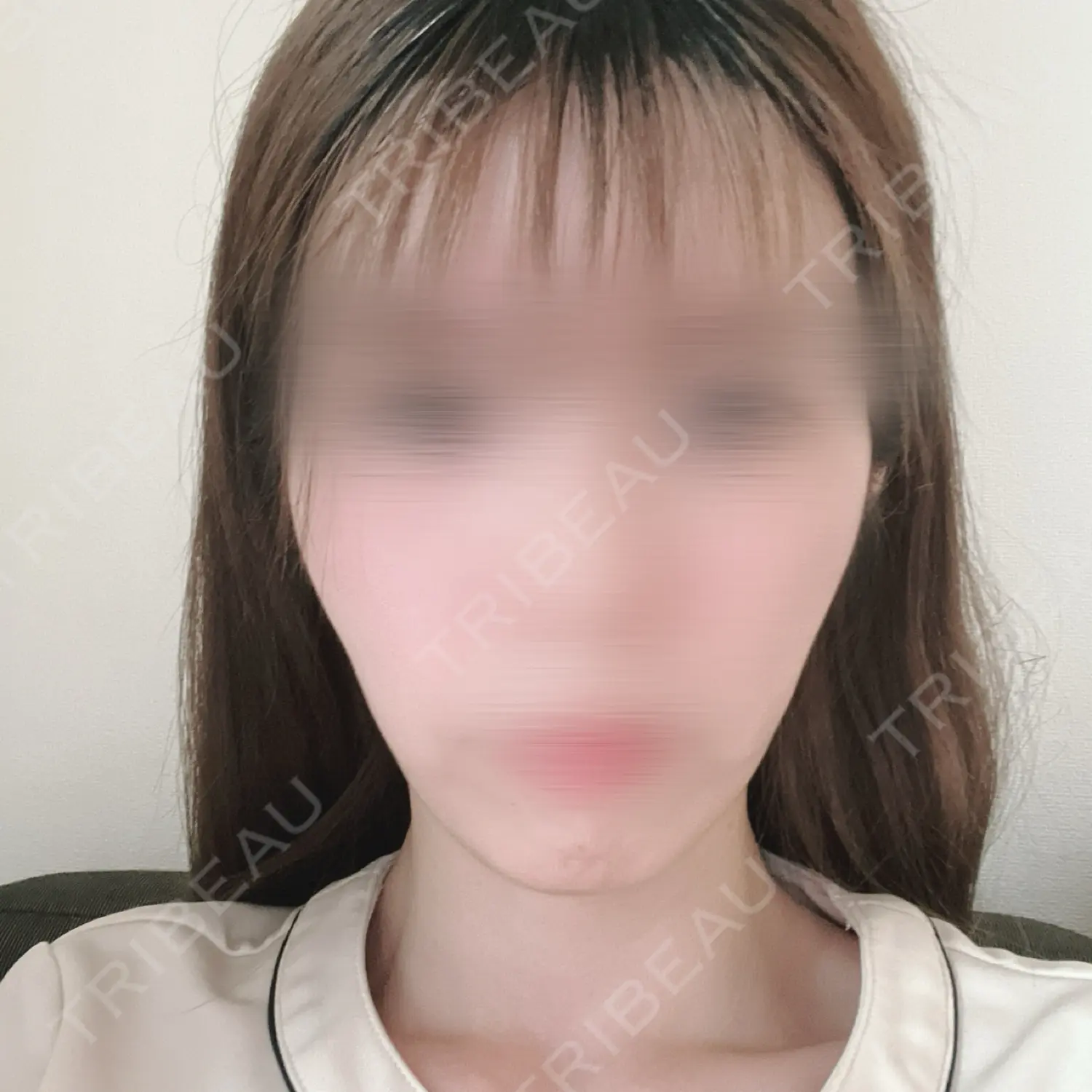 施術後の写真