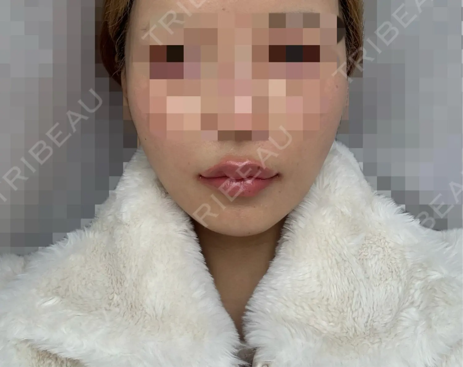 施術後の写真
