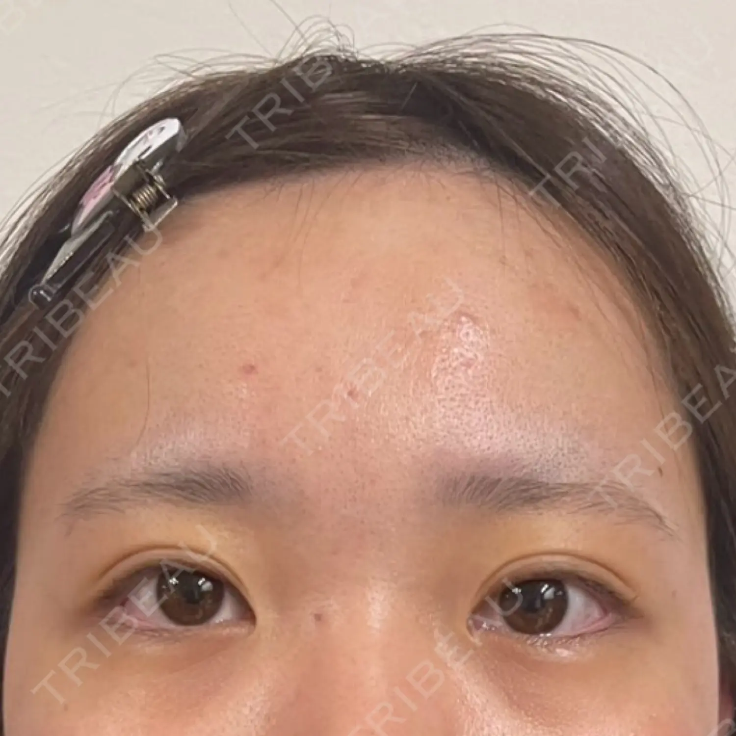 施術後の写真
