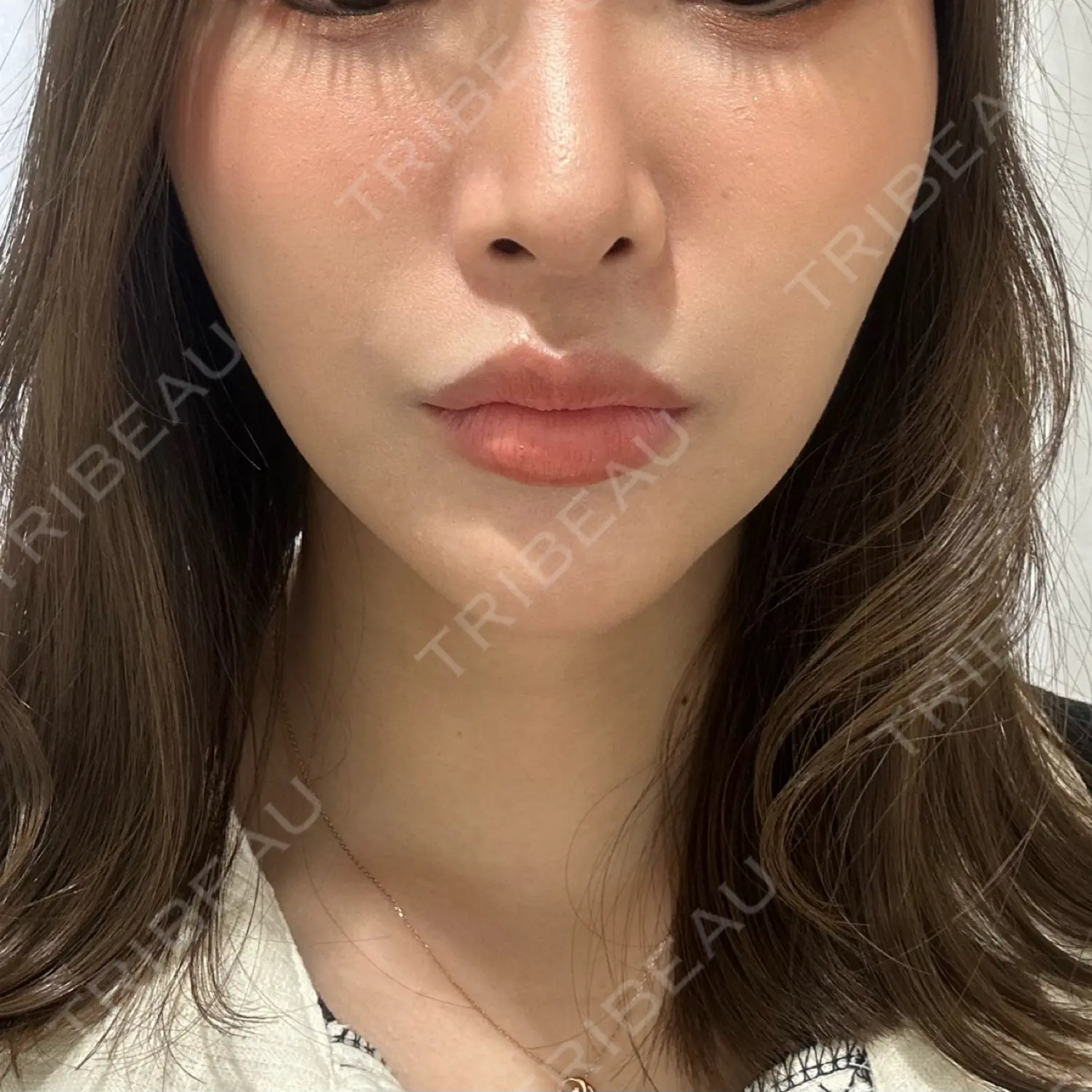 施術後の写真
