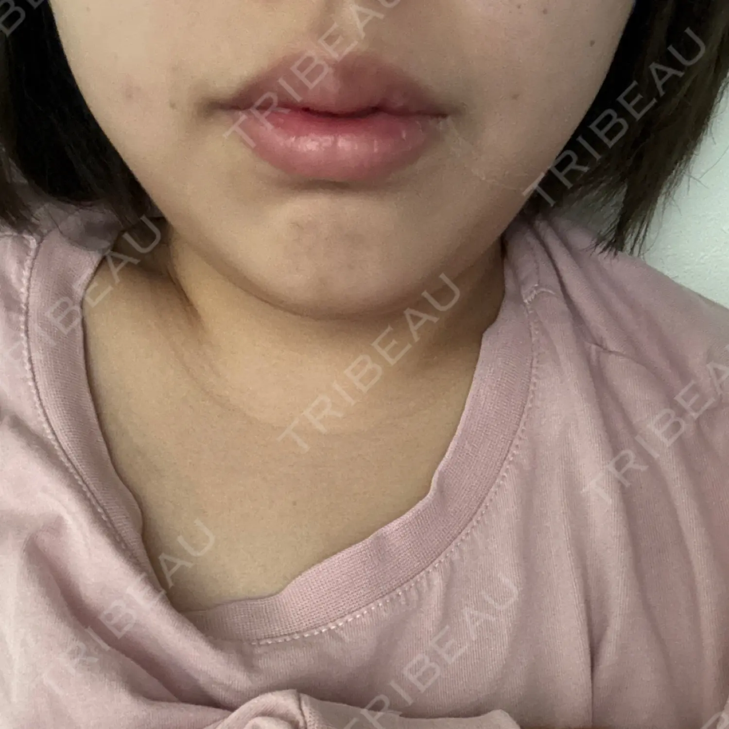 施術後の写真