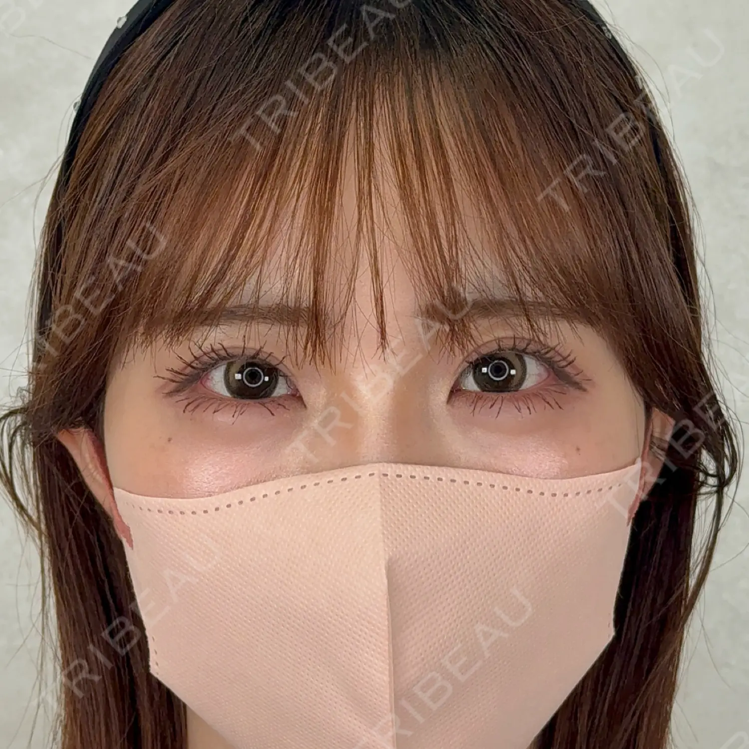 施術後の写真