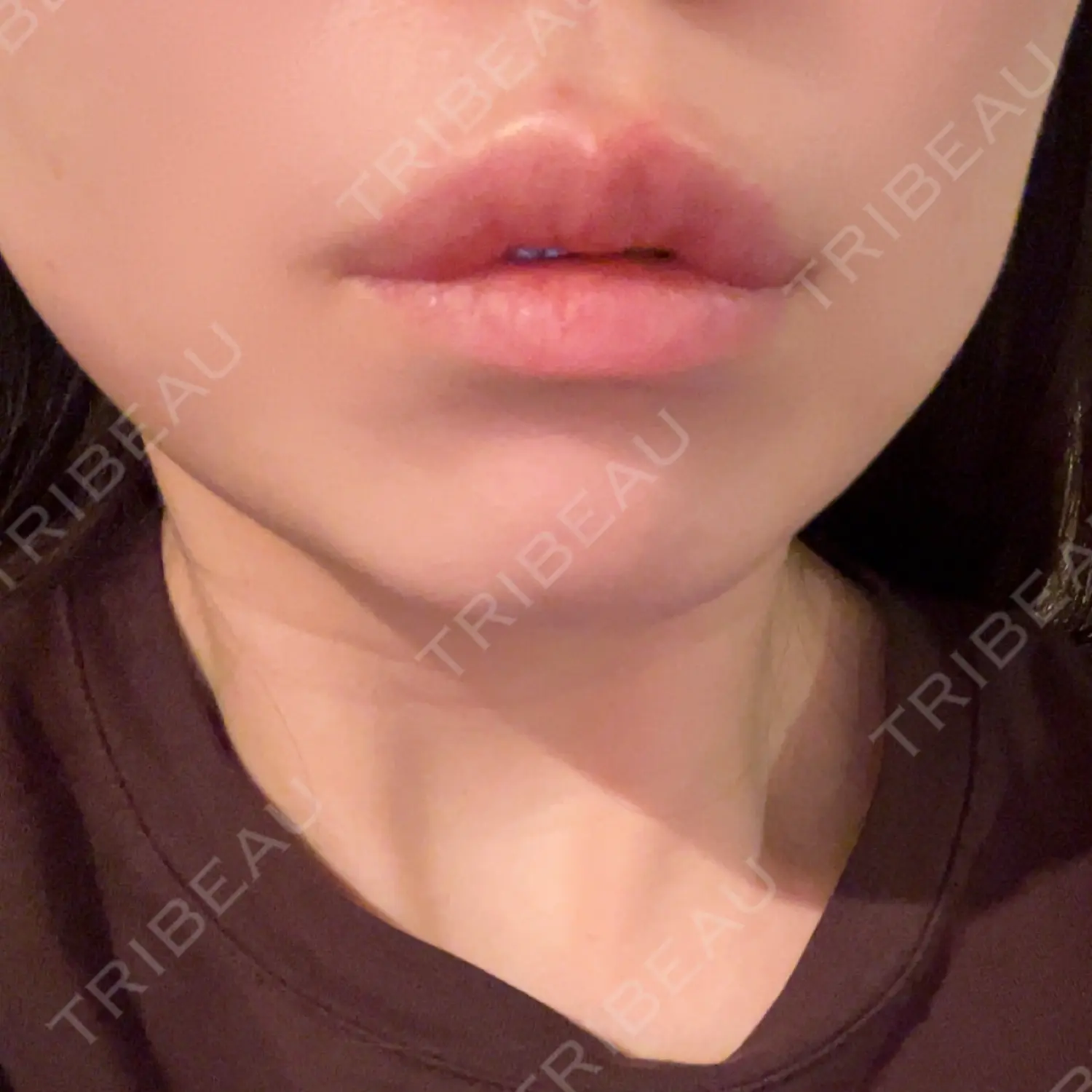 施術後の写真