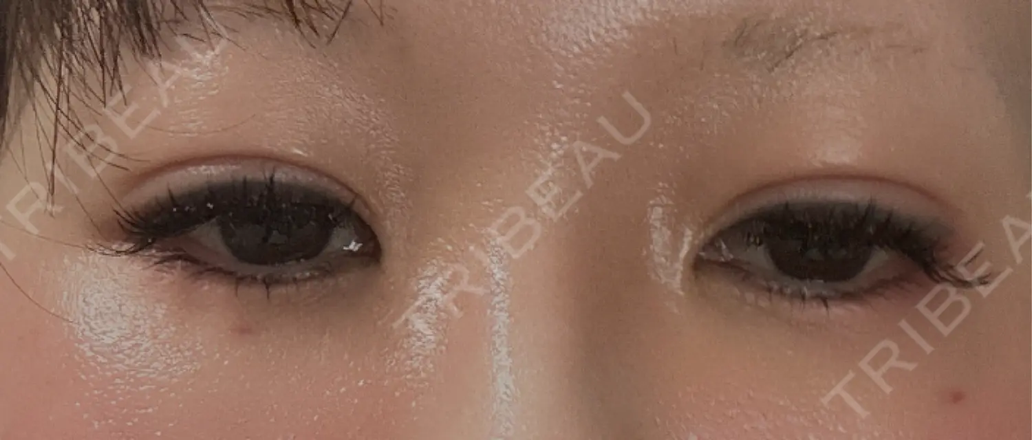 施術後の写真