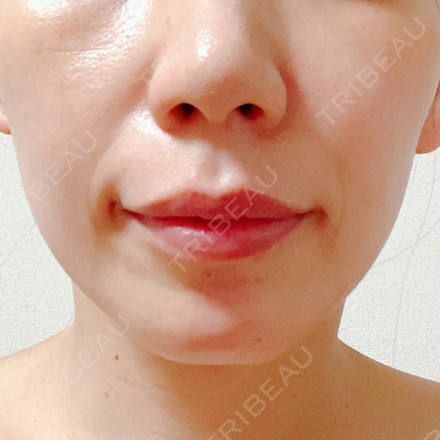 施術後の写真