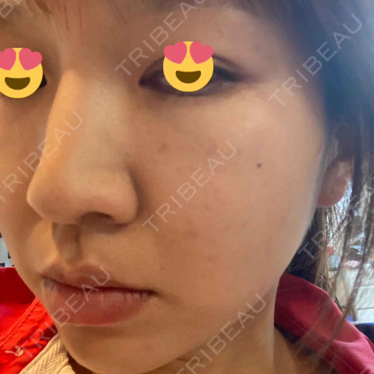 施術後の写真