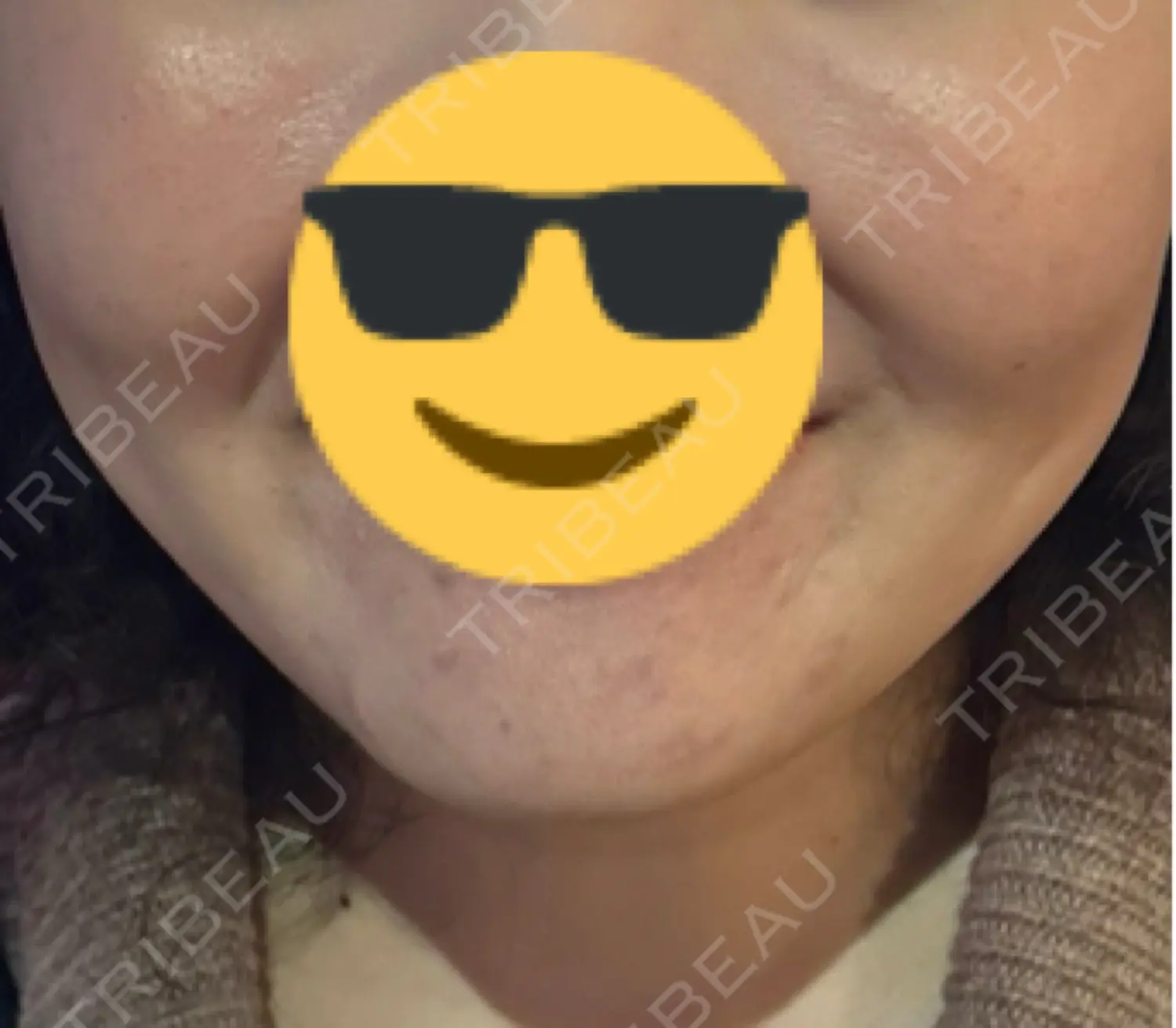 施術後の写真