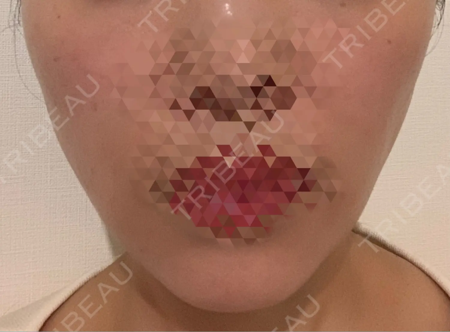施術後の写真