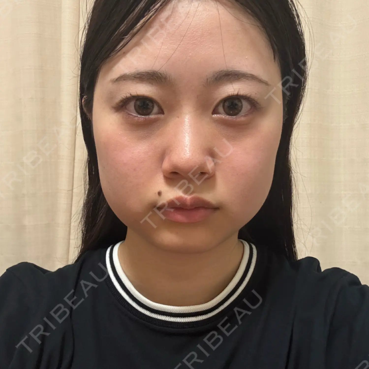 施術後の写真