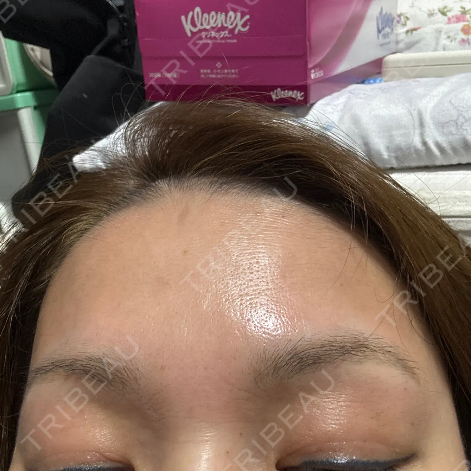 施術後の写真