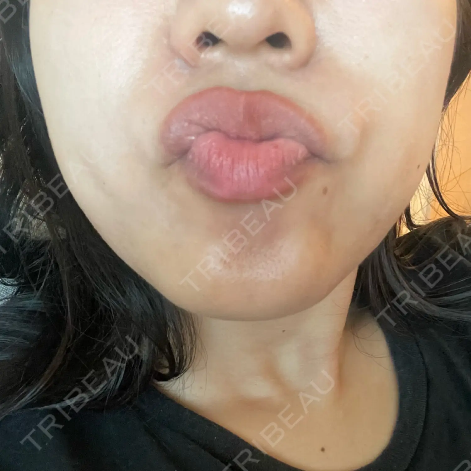 施術後の写真