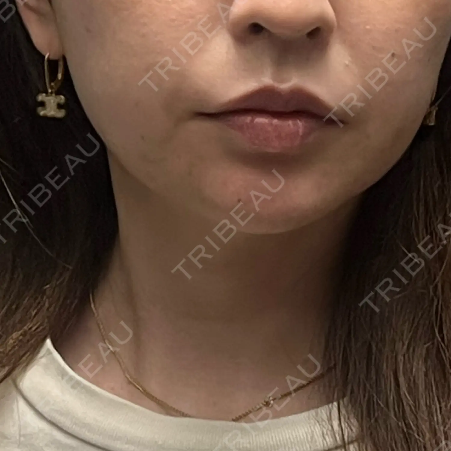 施術後の写真