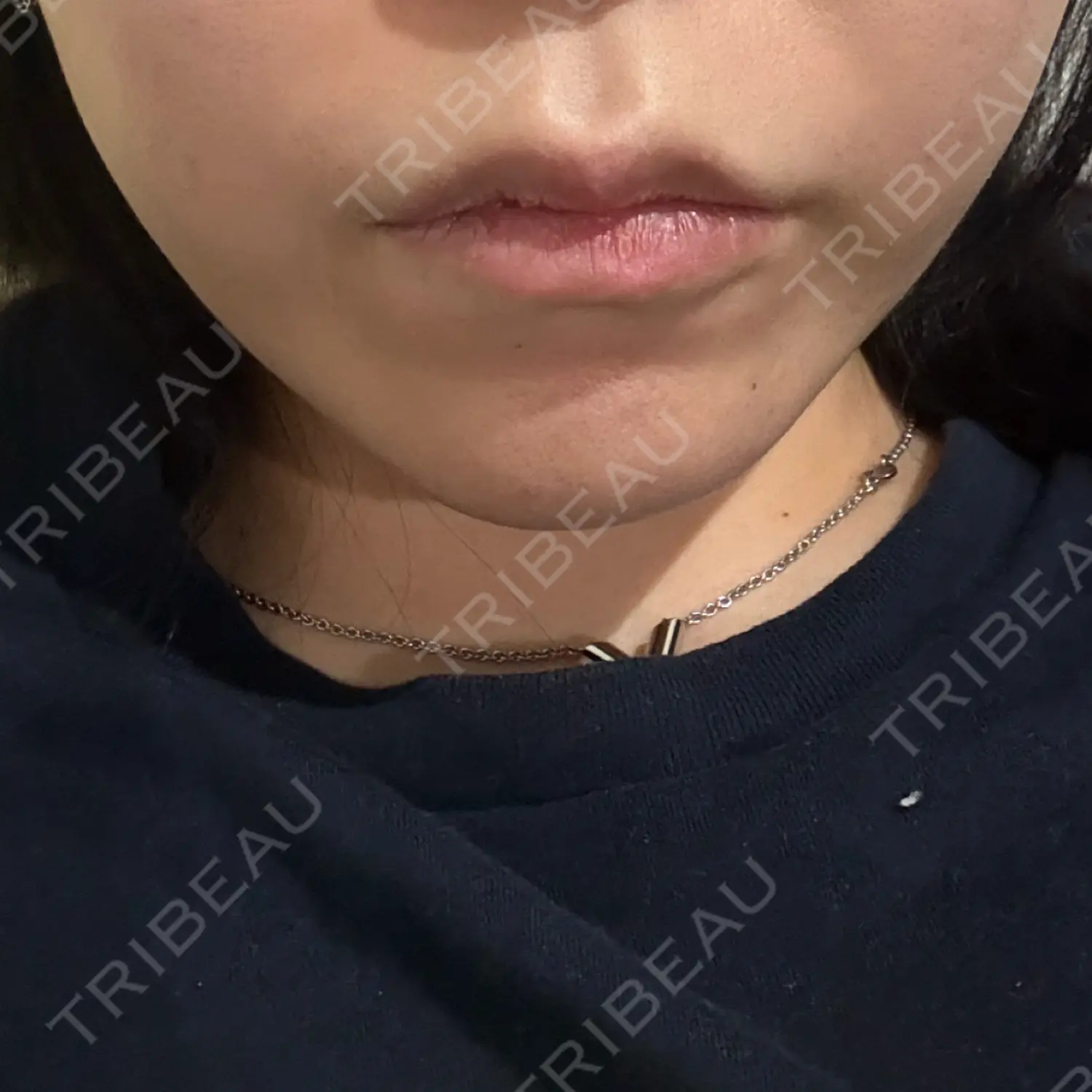 施術後の写真