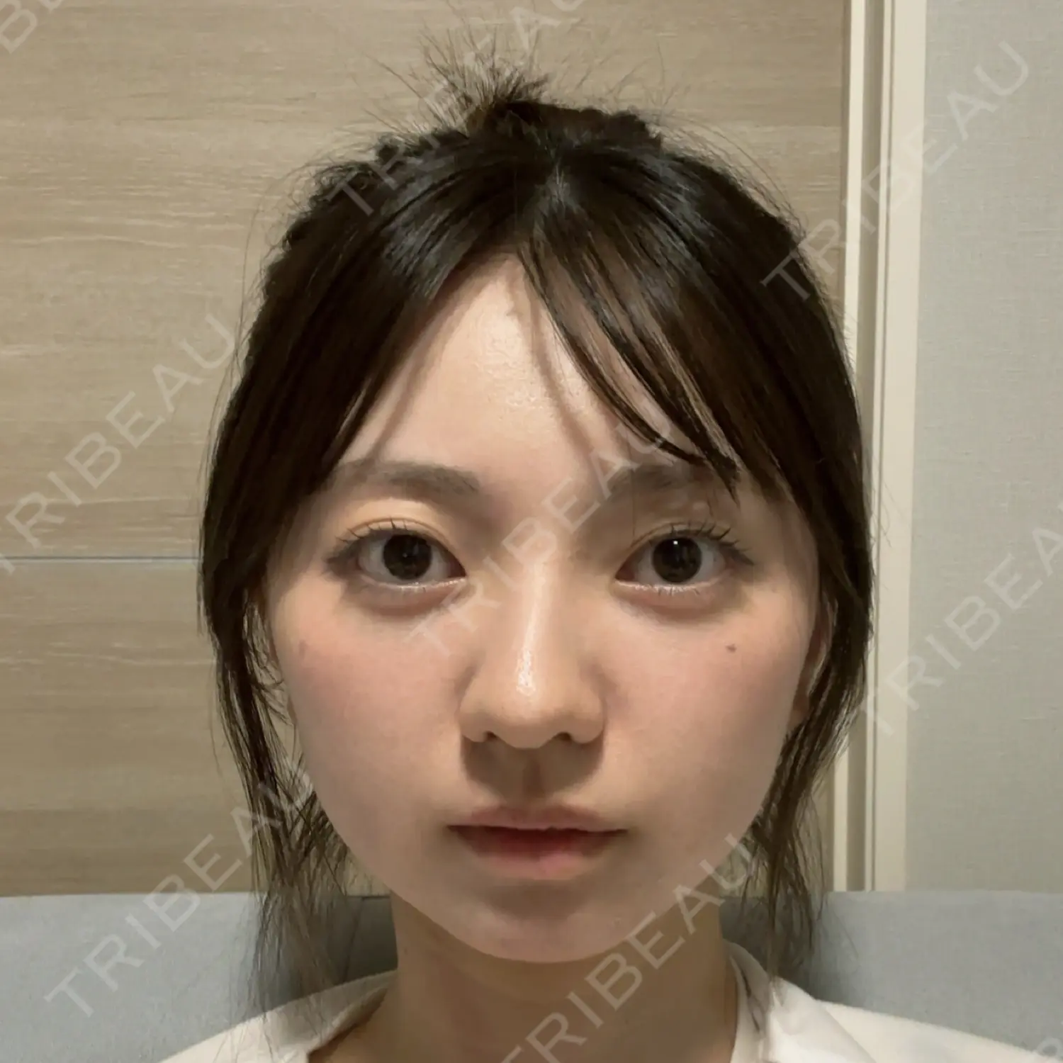 施術後の写真